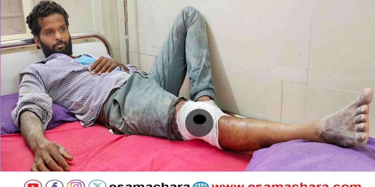 Monkey Attack/ ಕಾರ್ಮಿಕನ ಕಾಲಿಗೆ ಕಚ್ಚಿ ಗಾಯಗೊಳಿಸಿದ ಕೋತಿ.  ಗಂಭೀರ ಗಾಯಗೊಂಡು ಆಸ್ಪತ್ರೆಗೆ ದಾಖಲು